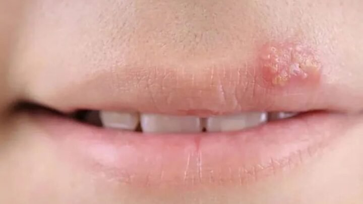 Herpes: causas, síntomas y consejos para prevenir brotes