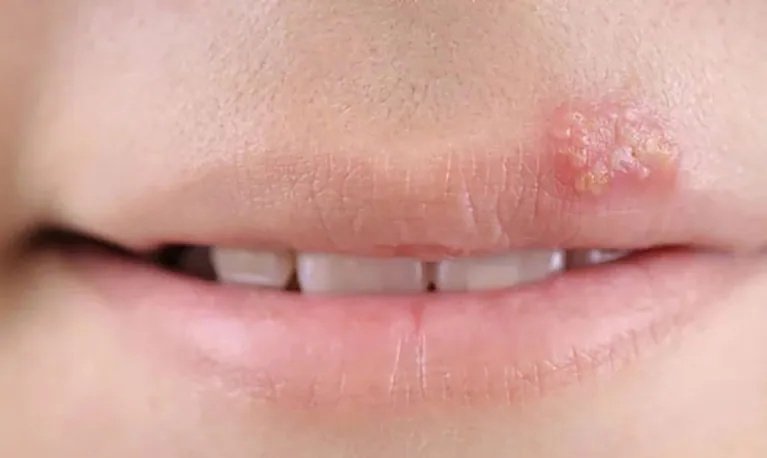 Herpes: causas, síntomas y consejos para prevenir brotes