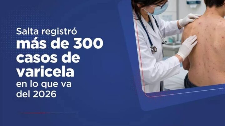 casos de varicela en Salta
