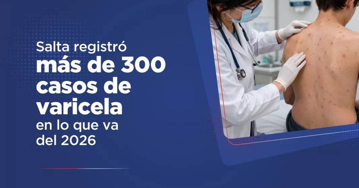 casos de varicela en Salta