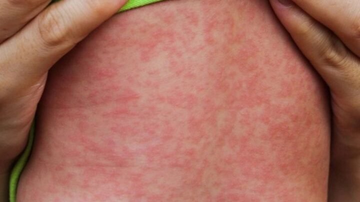Alerta sanitaria por el aumento de sarampión en las Américas: recomiendan revisar el esquema de vacunación antes de viajar