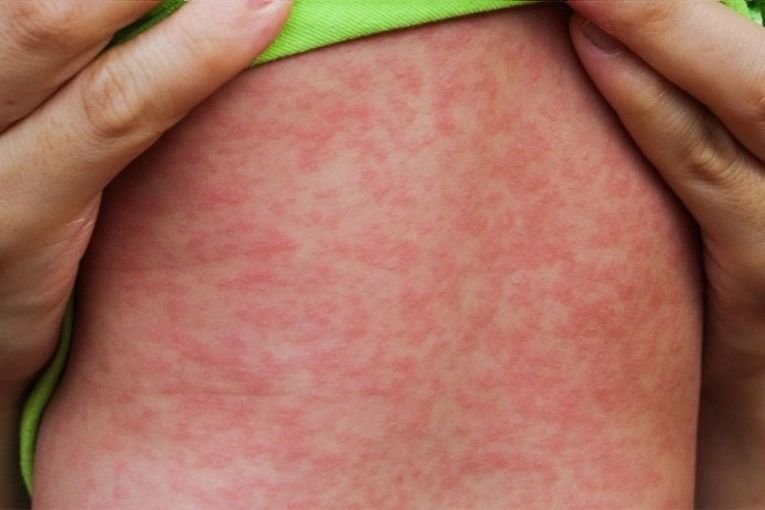 Alerta sanitaria por el aumento de sarampión en las Américas: recomiendan revisar el esquema de vacunación antes de viajar