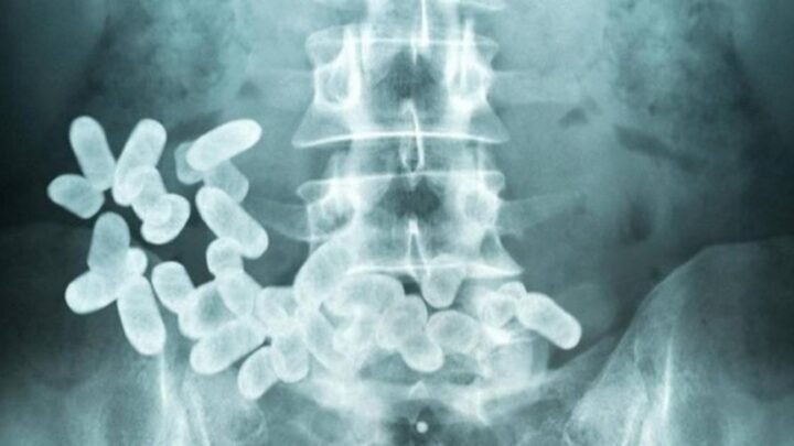 Deambuló moribundo, con 40 cápsulas de cocaína en el cuerpo