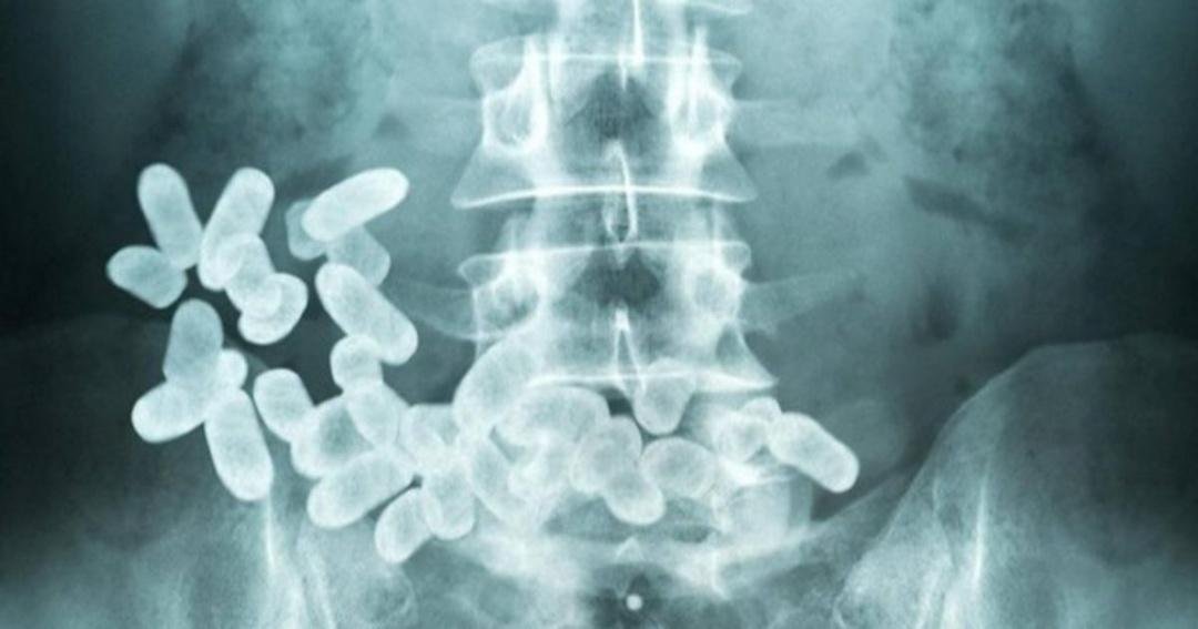 Deambuló moribundo, con 40 cápsulas de cocaína en el cuerpo