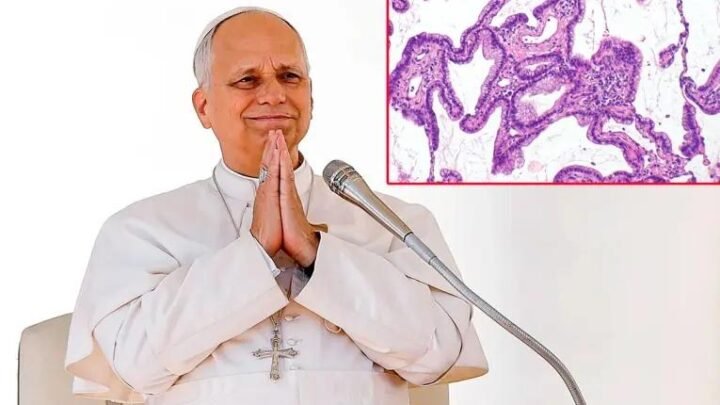 Qué es el adenocarcinoma pulmonar detectado al Papa: síntomas, causas y tratamientos de este tipo de cáncer